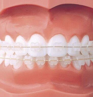 Ceramic braces are made from a material that is less visible than metal braces. For this reason, older teenagers and adults who are concerned about the appearance of braces usually select ceramic braces. Ceramic braces do require more attention and care because they are larger and made from a more brittle material than metal braces so they are often used only on the upper front teeth.